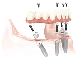 Periodontist in Frankfort,IL