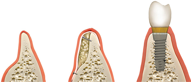 Bone Grafting in Frankfort, IL