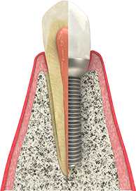 Dental Implants Monee, IL